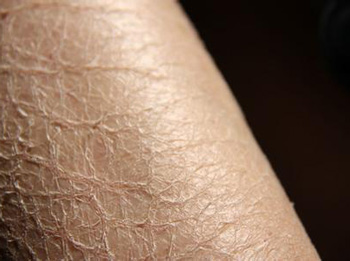 腿上皮肤干燥像鱼鳞怎么办