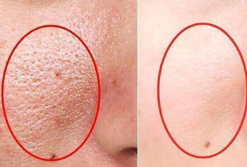 阿达帕林凝胶可以收缩毛孔吗，会得激素脸吗  阿达帕林 凝胶 激素脸 美白祛黄 第3张