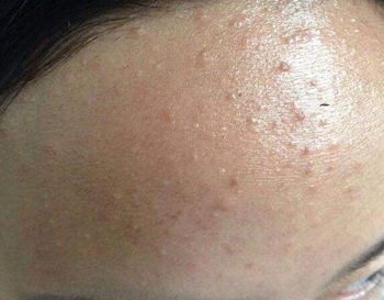 异维a酸可以永久控油是真的吗，能去黑头吗