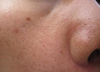 异维a酸可以永久控油是真的吗，能去黑头吗  异维a酸 控油 去黑头 美白祛黄 第3张