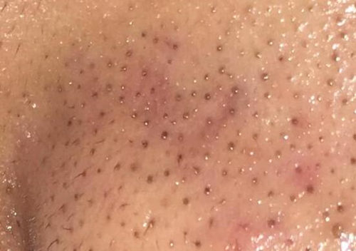 草莓鼻最好的治疗方法都有啥，正确打开方式都在这里