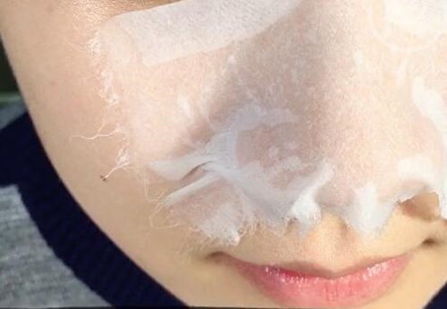 草莓鼻最好的治疗方法都有啥，正确打开方式都在这里  草莓鼻 治疗方法 美白祛黄 第5张