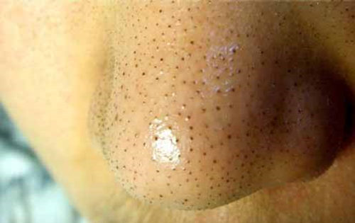 草莓鼻可以激光治疗吗价格如何