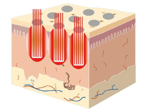 草莓鼻可以激光治疗吗价格如何  草莓鼻 激光 价格 美白祛黄 第3张