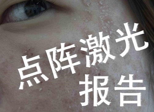 草莓鼻可以激光治疗吗价格如何  草莓鼻 激光 价格 美白祛黄 第4张