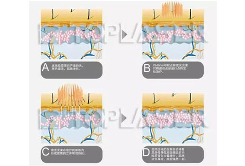 草莓鼻可以激光治疗吗价格如何  草莓鼻 激光 价格 美白祛黄 第5张