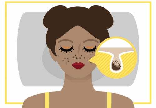抹了面霜黑头会变多怎么回事如何减少