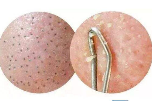 抹了面霜黑头会变多怎么回事如何减少  黑头 面霜 美白祛黄 第3张