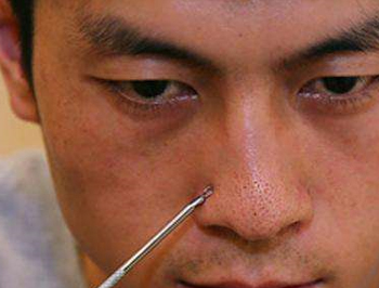 粉刺针去黑头会留洞吗，去黑头必看  去黑头 粉刺针 美白祛黄 第3张