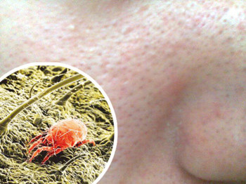 怎样去螨虫收毛孔，不可不看的螨虫危害