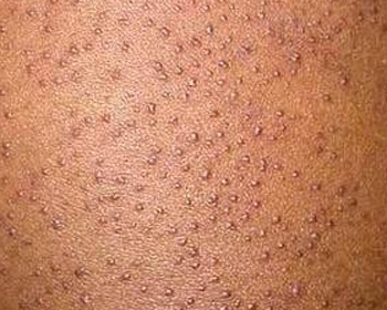 如何判断毛孔堵塞，教你正确判断毛孔问题  毛孔堵塞 美白祛黄 第3张