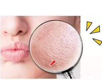 如何判断毛孔堵塞，教你正确判断毛孔问题  毛孔堵塞 美白祛黄 第5张