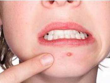 下巴毛孔堵塞长小颗粒怎么改善