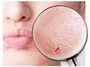 干性皮肤毛孔大怎么办，五大解决方法