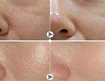 激光缩毛孔是永久的吗，有副作用吗  激光 副作用 美白祛黄 第3张