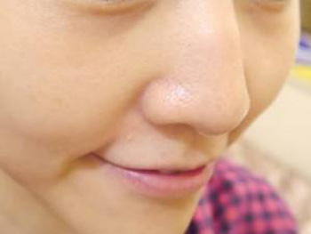 激光缩毛孔是永久的吗，有副作用吗  激光 副作用 美白祛黄 第4张