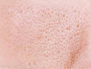 面部毛孔粗大的原因，全面分析6大原因  毛孔粗大 美白祛黄 第3张