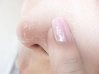 鼻子两侧毛孔粗怎么办，针对原因解决