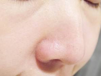 鼻子两侧毛孔粗怎么办，针对原因解决  收缩毛孔 美白祛黄 第5张