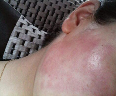 用寡肽原液把脸毁了，烂脸原因到底是啥