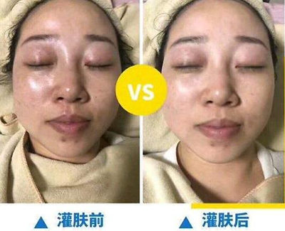 伊蓓诺水疗灌肤疗法怎么做，后续排异反应正常吗