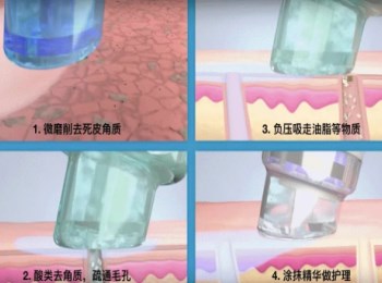 小气泡清洁后突然爆痘怎么办，小气泡清洁有什么好处  小气泡清洁 爆痘 美白祛黄 第2张