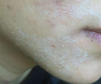 脸脱皮怎么办快速恢复方法推荐