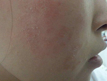 脸上起干皮像癣一样怎么回事，怎么改善