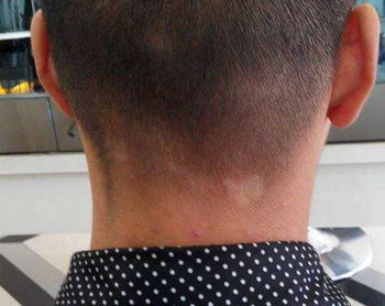 脸上起干皮像癣一样怎么回事，怎么改善  回事 皮像癣 美白祛黄 第6张