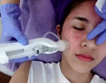 黄金微针和水光针区别，哪个好用  黄金微针 水光针 美白祛黄 第2张