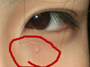 去脂肪粒最有效的方法，安全缓解脂肪粒  脂肪 方法 美白祛黄 第1张