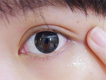 去脂肪粒最有效的方法，安全缓解脂肪粒  脂肪 方法 美白祛黄 第5张