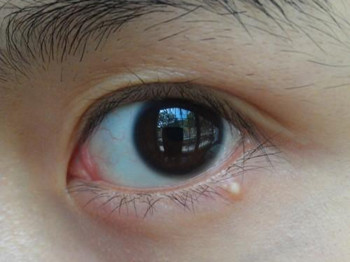 脂肪粒能用针挑吗，正确去除脂肪粒  脂肪 美白祛黄 第1张