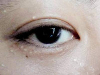 脂肪粒能用针挑吗，正确去除脂肪粒  脂肪 美白祛黄 第3张