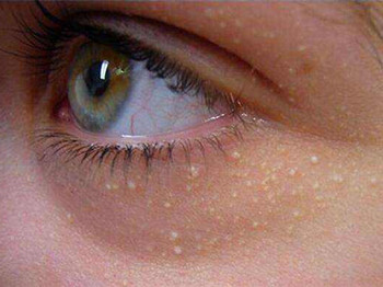 去除眼部脂肪粒小偏方，五个实用小方法