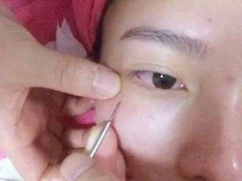 去除眼部脂肪粒小偏方，五个实用小方法  偏方 眼部 脂肪 美白祛黄 第2张