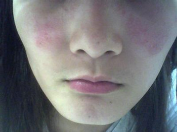 水光针出现过敏怎么办,根据原因找对策 水光 怎么办 美白祛黄 第2张 水光针出现过敏怎么办,根据原因找对策 水光 怎么办 美白祛黄 第2张