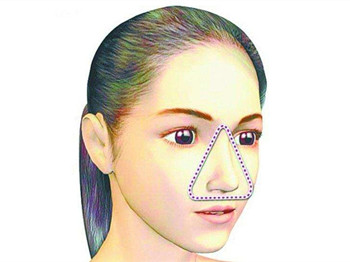 脸部三角区出油怎么办，找准原因对症解决