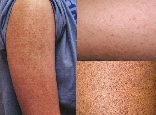 盐能去鸡皮肤吗，怎么使用