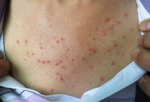 胸口皮肤像鸡皮一样痒怎么回事 鸡皮 美白祛黄 第2张 胸口皮肤像鸡皮一样痒怎么回事 鸡皮 美白祛黄 第2张