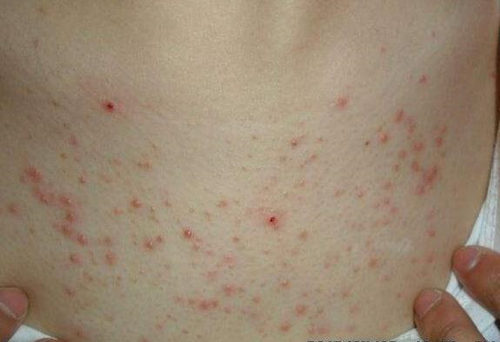 胸口皮肤像鸡皮一样痒怎么回事 鸡皮 美白祛黄 第3张 胸口皮肤像鸡皮一样痒怎么回事 鸡皮 美白祛黄 第3张