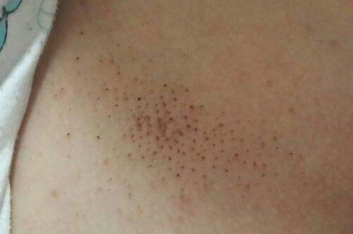 胸口皮肤像鸡皮一样痒怎么回事 鸡皮 美白祛黄 第4张 胸口皮肤像鸡皮一样痒怎么回事 鸡皮 美白祛黄 第4张