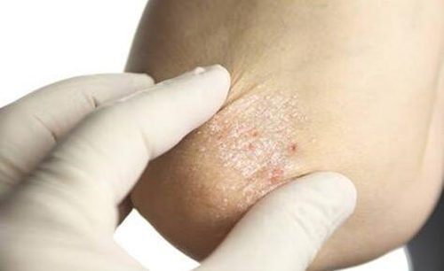 鸡皮肤洗澡后痒怎么回事，这几个方法能改善  洗澡 痒 美白祛黄 第2张