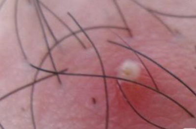 脸部毛囊受损要怎么修复，推荐这五个有效方法