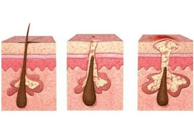 脸部毛囊受损要怎么修复，推荐这五个有效方法  毛囊 毛囊受损 方法 美白祛黄 第2张