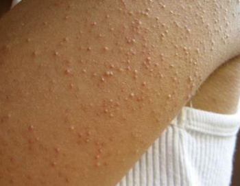 果酸治疗毛周角化症，刷酸要慎重