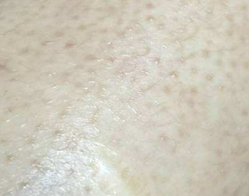 果酸治疗毛周角化症，刷酸要慎重  果酸 毛囊角化症 美白祛黄 第2张