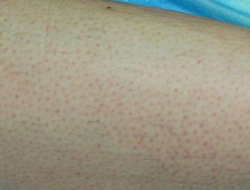 果酸治疗毛周角化症，刷酸要慎重  果酸 毛囊角化症 美白祛黄 第3张