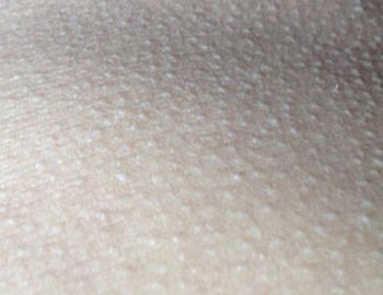 轻度毛囊角化症缺什么，怎么补