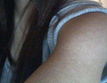 轻度毛囊角化症缺什么，怎么补  毛囊角化症 美白祛黄 第2张